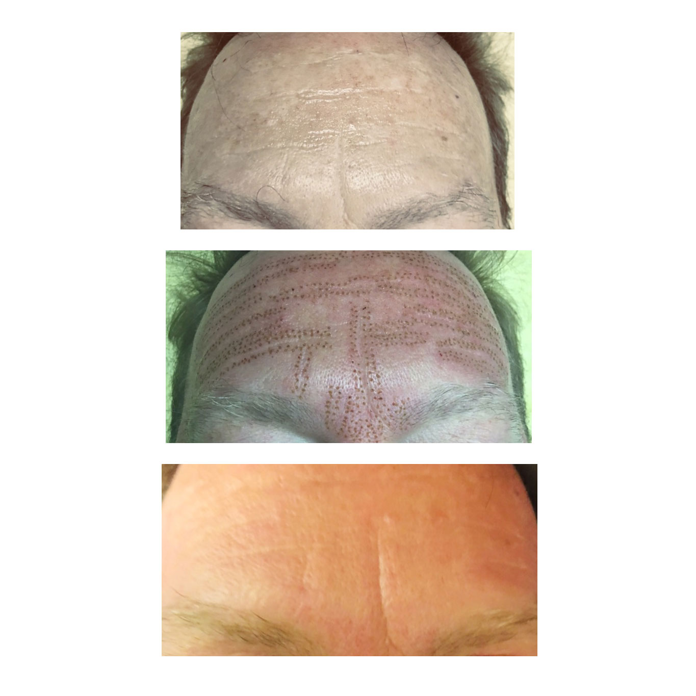 Dermabrasion Case