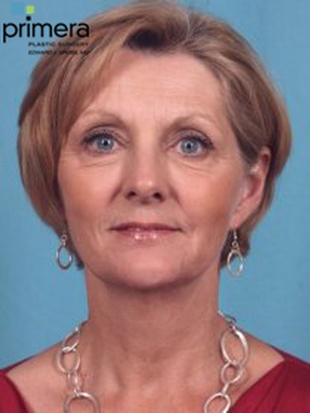 BOTOX® Cosmetic Case