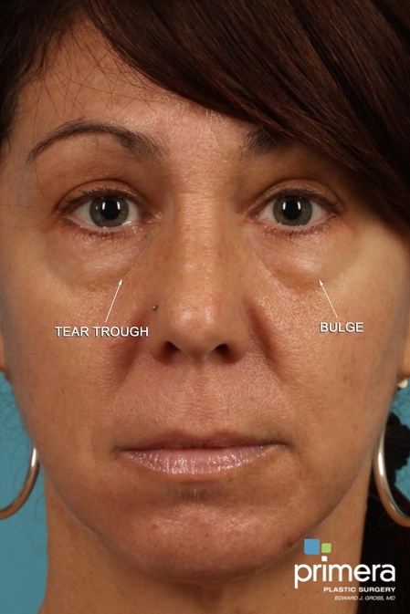 Restylane® Case