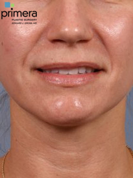 Restylane® Case