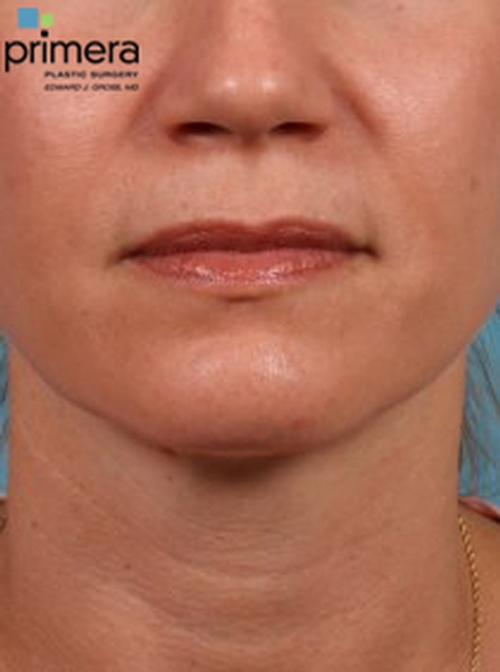 Restylane® Case