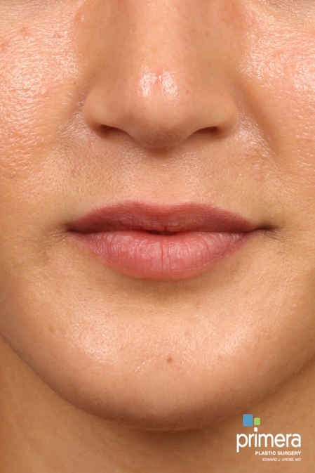 JUVÉDERM® Case