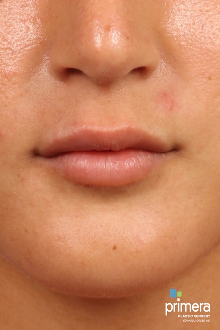 JUVÉDERM® Case